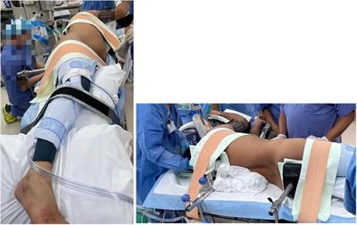 Retroperitoneal robot-assisted live-donor nephrectomy: A single-center study